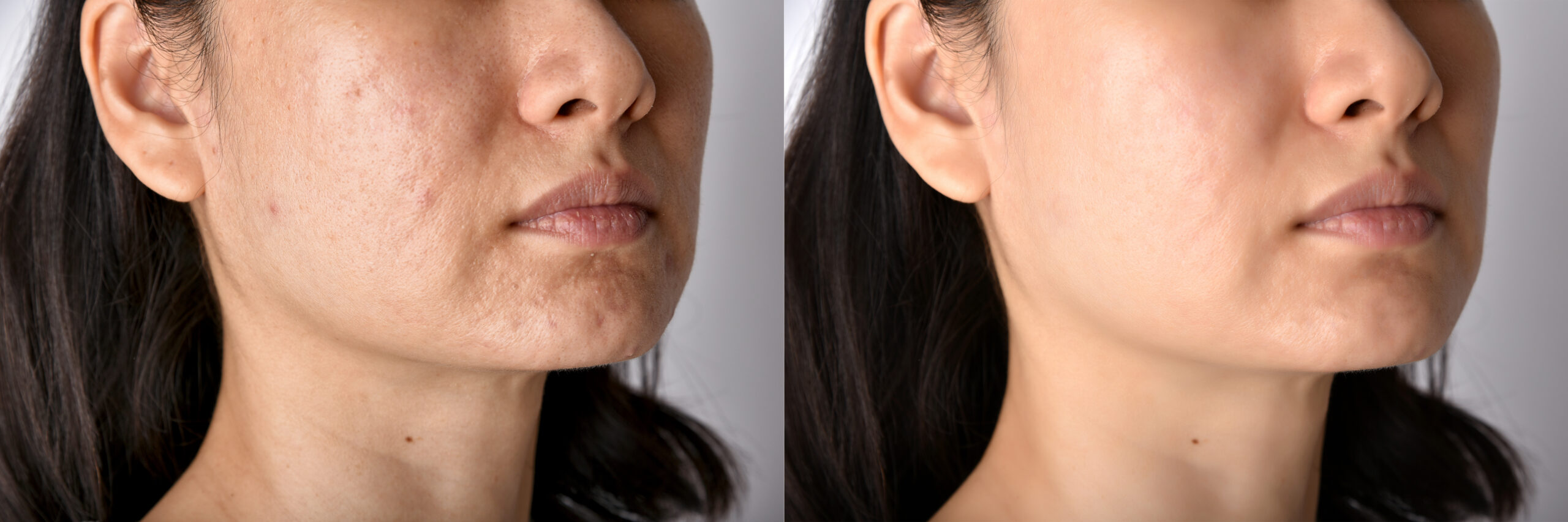 Scarlet Pro before and after result