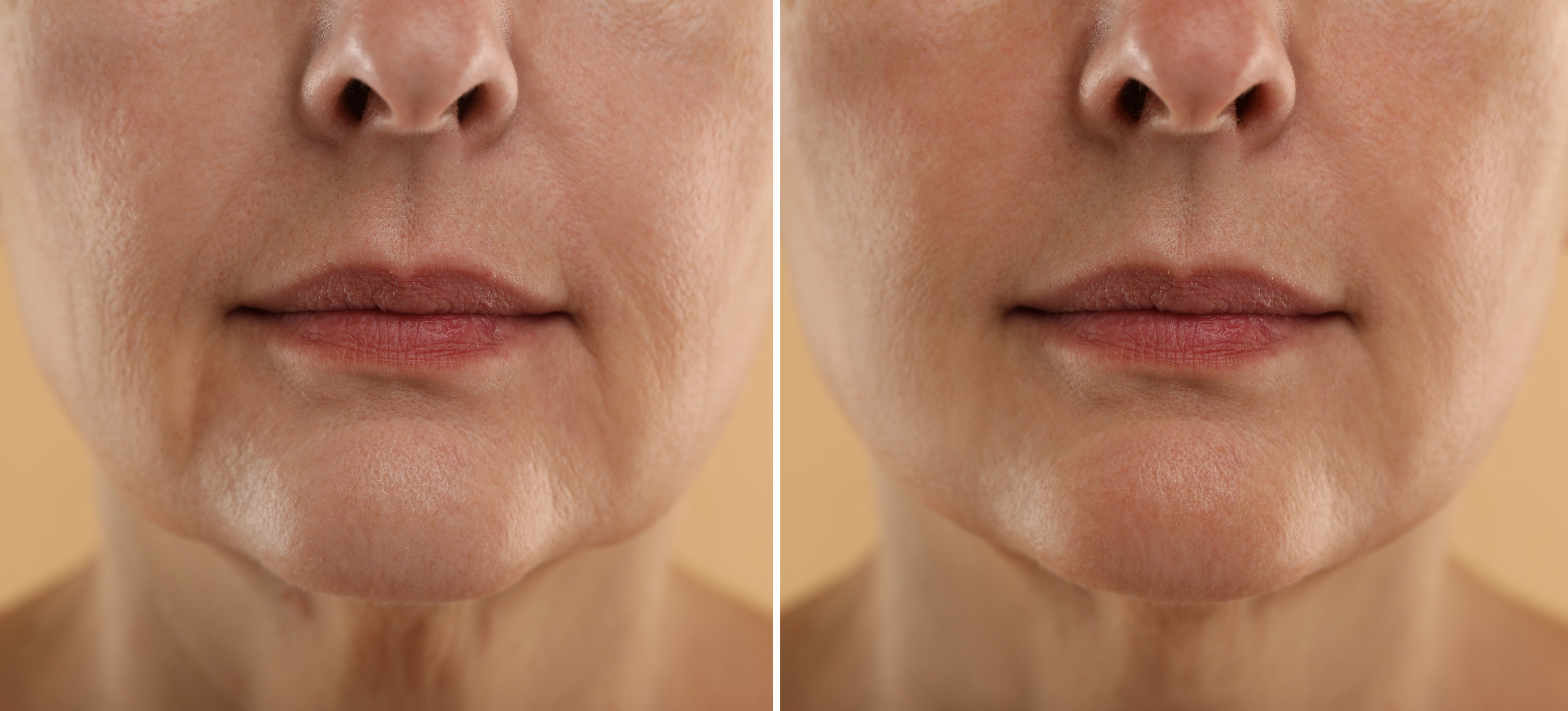 Scarlet Pro before and after result