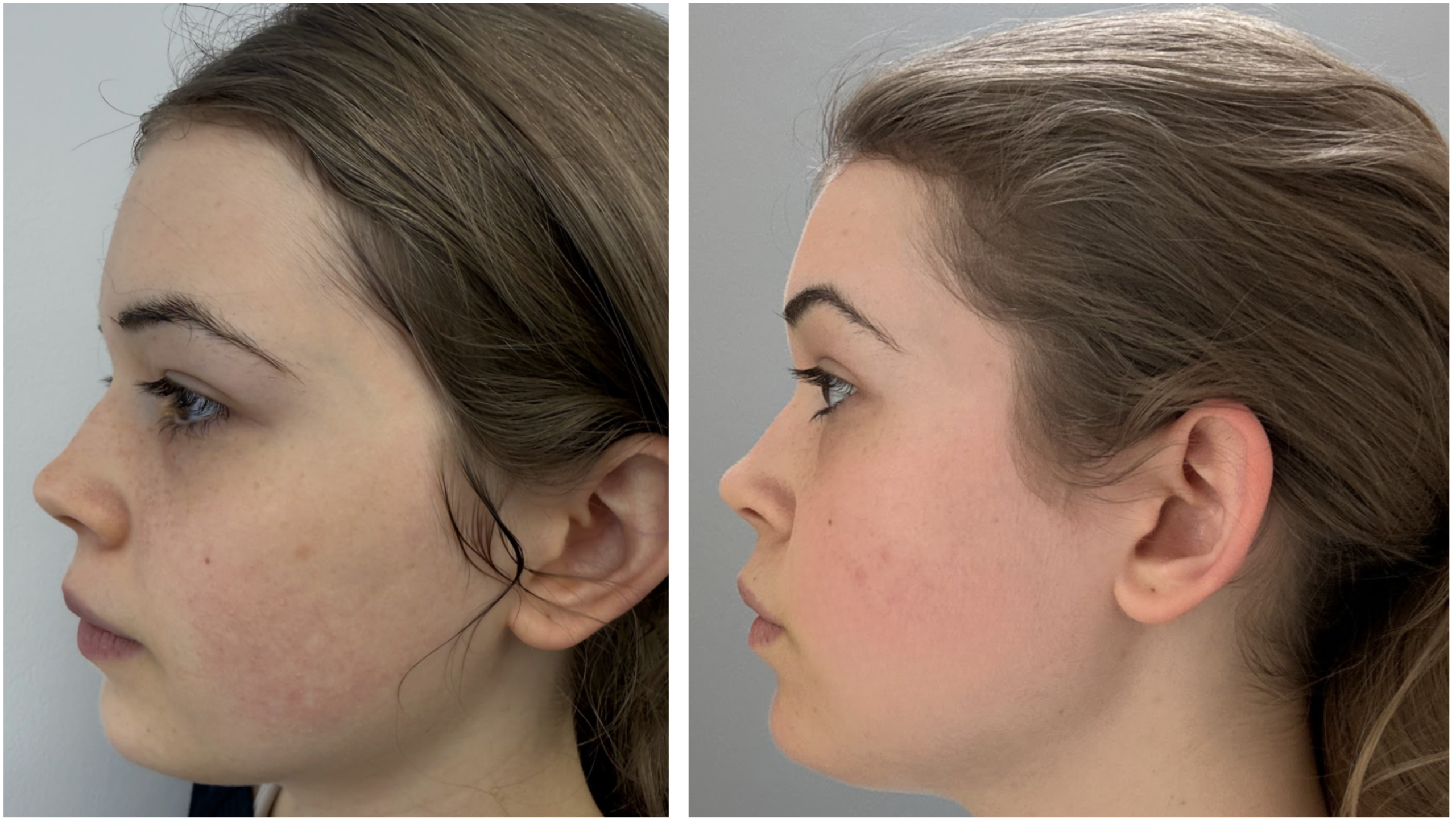 Scarlet Pro before and after result